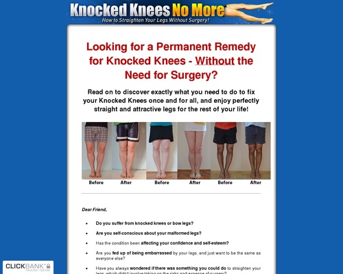 Knocked Knees No Extra – Tips on how to Straighten Your Legs With out Surgical procedure!